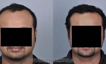 Hair transplantation surgery before and after photos