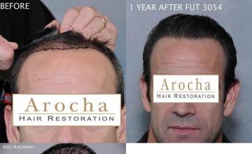 Hair restoration procedure before and after results