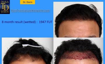 Hair restoration procedure before and after results