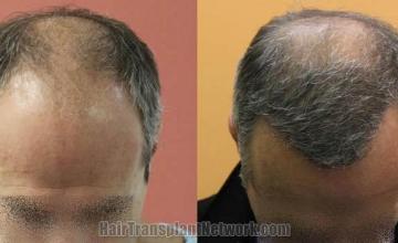 Hair transplantation surgery before and after photos