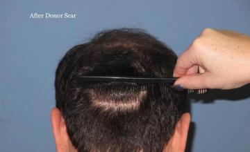 Hair transplantation surgery before and after pictures