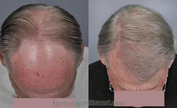 Hair transplantation surgery before and after photos