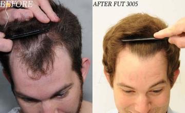 Hair transplantation surgery before and after photos