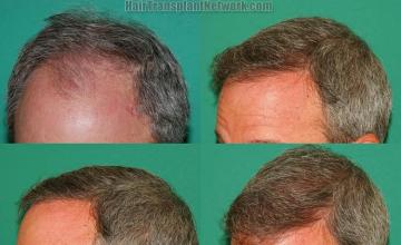 Hair transplantation surgery before and after pictures