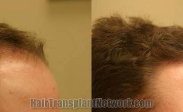 Hair transplantation surgery before and after images