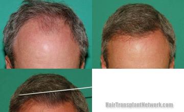 Hair transplantation surgery before and after photos