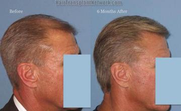 Hair transplantation surgery before and after images