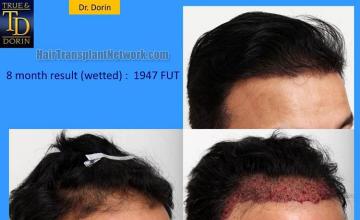 Hair transplantation surgery before and after images