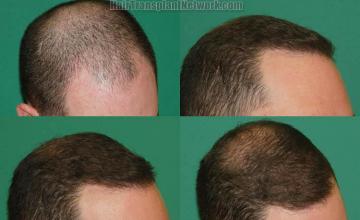 Hair transplantation surgery before and after images