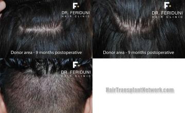 Hair restoration procedure before and after pictures