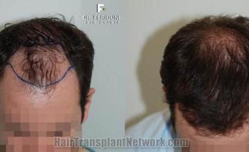 Hair transplantation surgery before and after photos