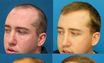 Hair transplantation surgery before and after images