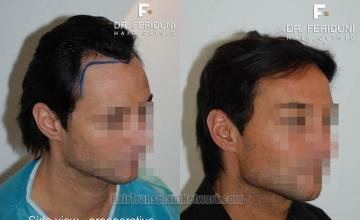 Hair transplantation surgery before and after images