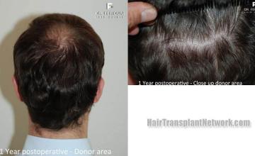 Hair restoration procedure before and after pictures