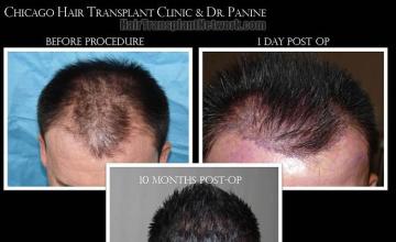 Hair transplantation surgery before and after photos