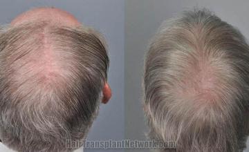 Hair transplantation surgery before and after pictures