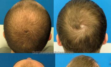 Hair transplantation surgery before and after pictures