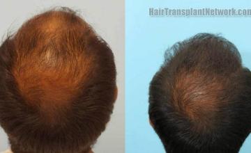 Hair transplantation surgery before and after pictures