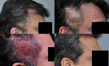 Hair transplantation surgery before and after pictures