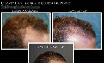 Hair transplantation surgery before and after photos