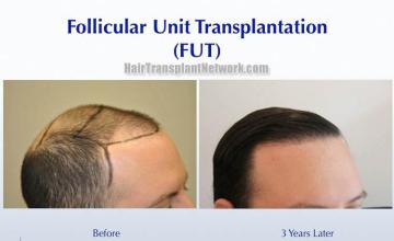 Hair restoration procedure before and after results