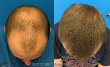 Hair restoration procedure before and after results