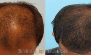 Hair transplantation surgery before and after photos