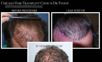 Hair transplantation surgery before and after photos