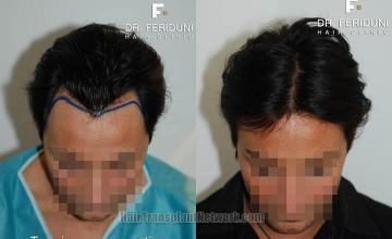 Hair transplantation surgery before and after photos