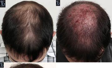 Hair restoration procedure before and after pictures