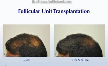 Hair transplantation surgery before and after photos