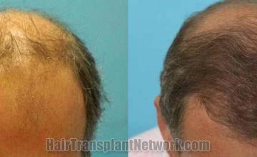 Hair transplantation surgery before and after pictures