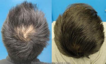 Hair restoration procedure before and after pictures