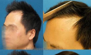 Hair transplantation surgery before and after pictures