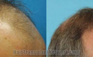 Hair restoration procedure before and after pictures