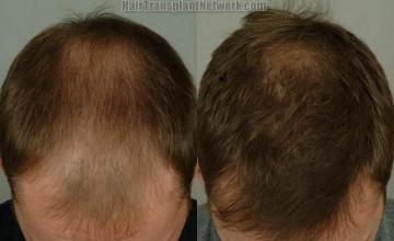 Hair restoration procedure before and after results