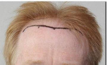 Hair restoration procedure results