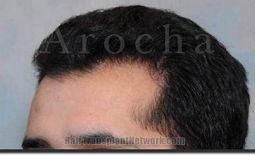 Hair restoration procedure results