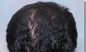 Hair restoration procedure results