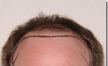 Hair restoration procedure results