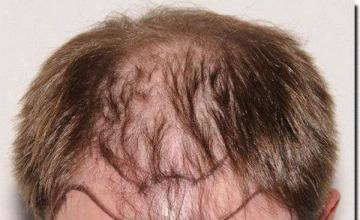 Hair restoration procedure results