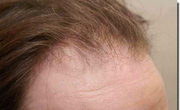 Hair restoration procedure results