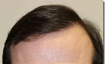 Hair restoration procedure results