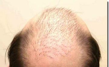 Hair restoration procedure results