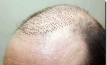 Hair restoration procedure results