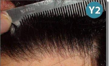 Hair restoration procedure results