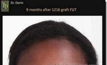 Hair restoration procedure results