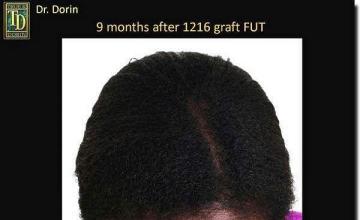 Hair restoration procedure results