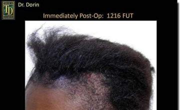 Hair restoration procedure results