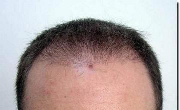 Hair restoration procedure results
